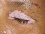 vitiligo