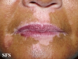 vitiligo