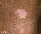 vitiligo