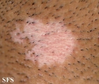 vitiligo