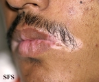vitiligo