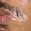 vitiligo