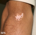 vitiligo