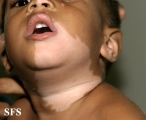 vitiligo