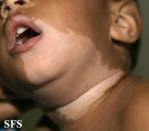 vitiligo