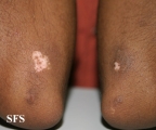 vitiligo