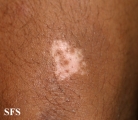 vitiligo