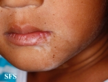 vitiligo