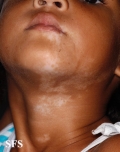 vitiligo
