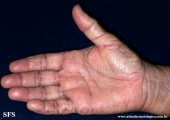 marginal keratoderma of the palms 