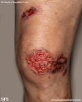 cryptococcosis-cutaneos_cryptococcus