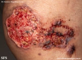 cryptococcosis-cutaneos_cryptococcus