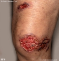 cryptococcosis-cutaneos_cryptococcus