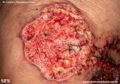 cryptococcosis-cutaneos_cryptococcus