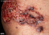 cryptococcosis-cutaneos_cryptococcus