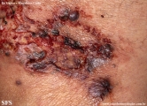 cryptococcosis-cutaneos_cryptococcus