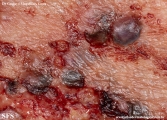 cryptococcosis-cutaneos_cryptococcus