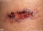 cryptococcosis-cutaneos_cryptococcus