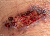 cryptococcosis-cutaneos_cryptococcus
