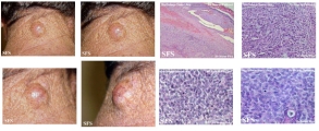 hidradenoma-malignant nodular hidradenoma