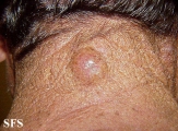 hidradenoma-malignant nodular hidradenoma