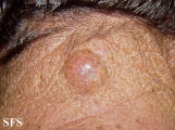 hidradenoma-malignant nodular hidradenoma