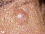 hidradenoma-malignant nodular hidradenoma