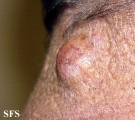 hidradenoma-malignant nodular hidradenoma