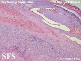 hidradenoma-malignant nodular hidradenoma