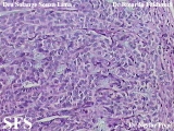 hidradenoma-malignant nodular hidradenoma