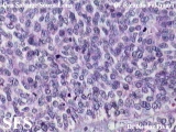 hidradenoma-malignant nodular hidradenoma