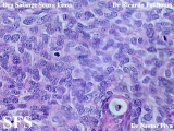 hidradenoma-malignant nodular hidradenoma