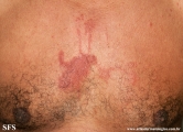 phytophotodermatitis
