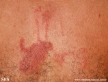 phytophotodermatitis