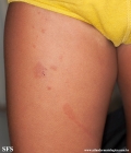 phytophotodermatitis