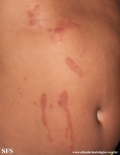 phytophotodermatitis