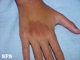 phytophotodermatitis
