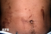 phytophotodermatitis