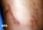 phytophotodermatitis