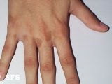 phytophotodermatitis