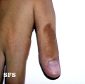 phytophotodermatitis