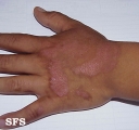 phytophotodermatitis