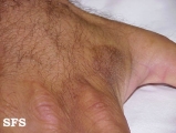phytophotodermatitis