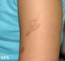 phytophotodermatitis