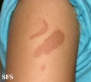 phytophotodermatitis