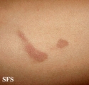 phytophotodermatitis
