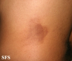 phytophotodermatitis