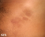 phytophotodermatitis