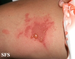 phytophotodermatitis