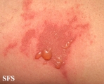 phytophotodermatitis